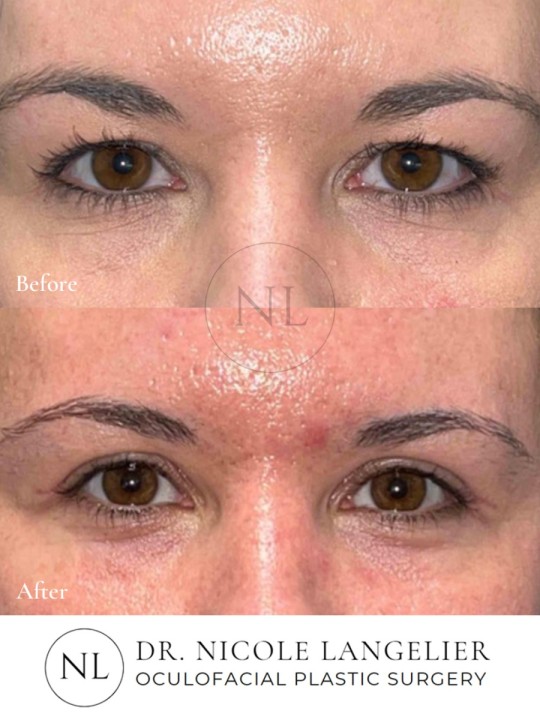 Female Upper Eyelid Blepharoplasty