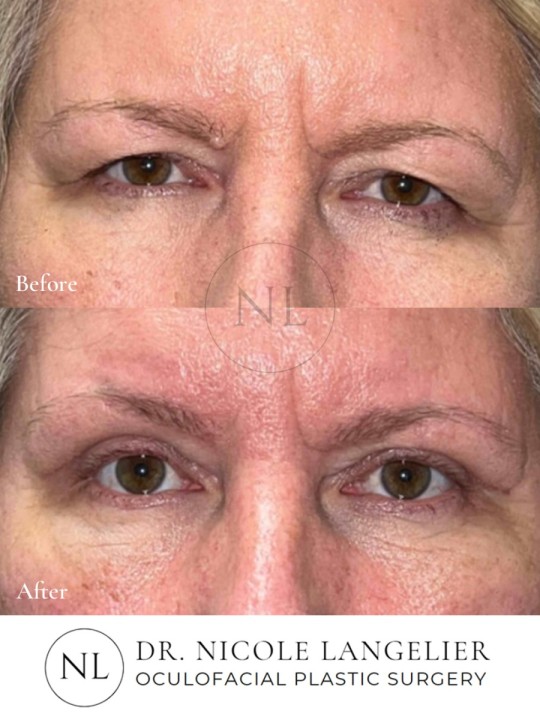 Female Upper Eyelid Blepharoplasty
