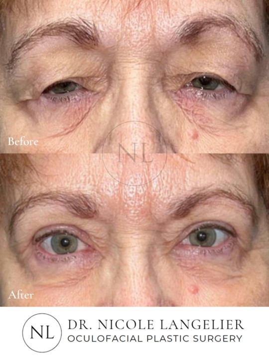 Female Upper Eyelid Blepharoplasty