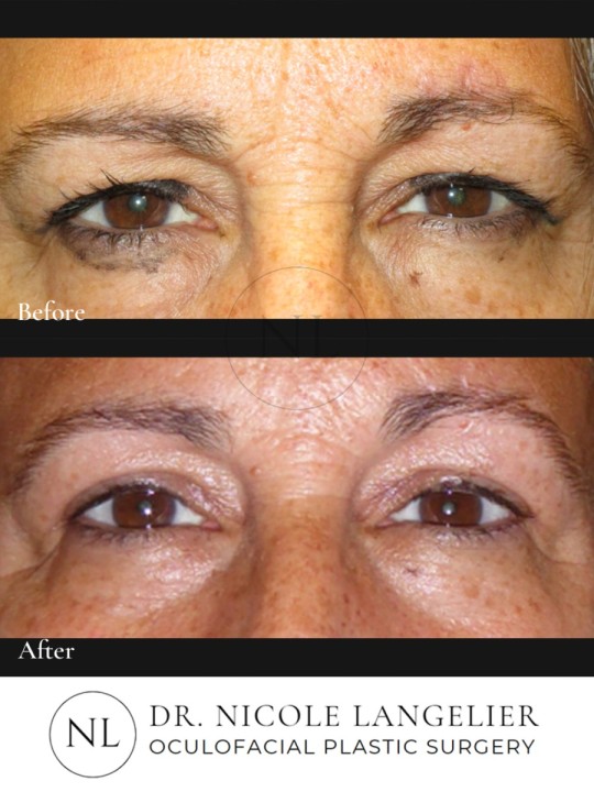 Bilateral Upper Eyelid Blepharoplasty