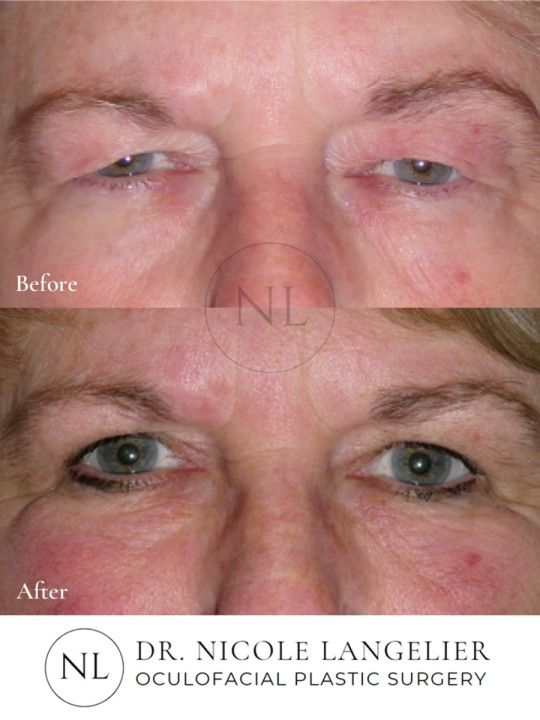 Bilateral Upper Eyelid Blepharoplasty