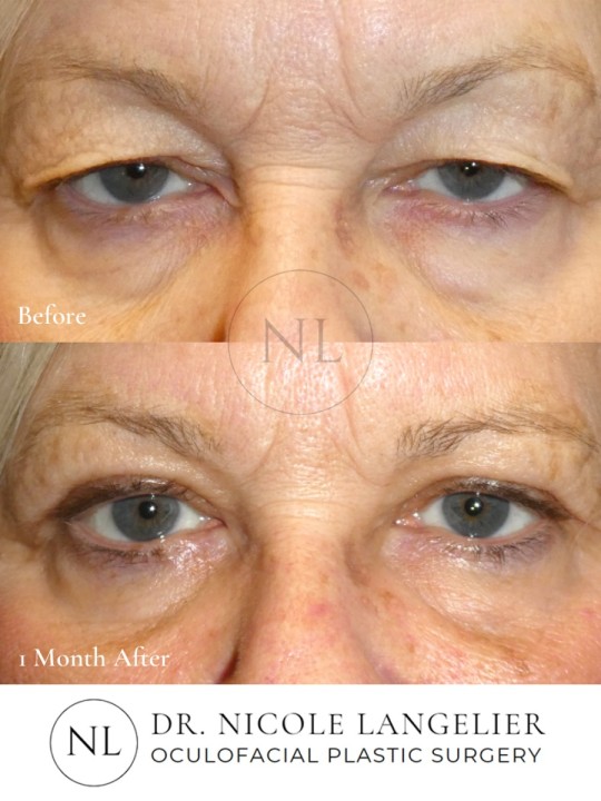 Female Upper Eyelid Blepharoplasty