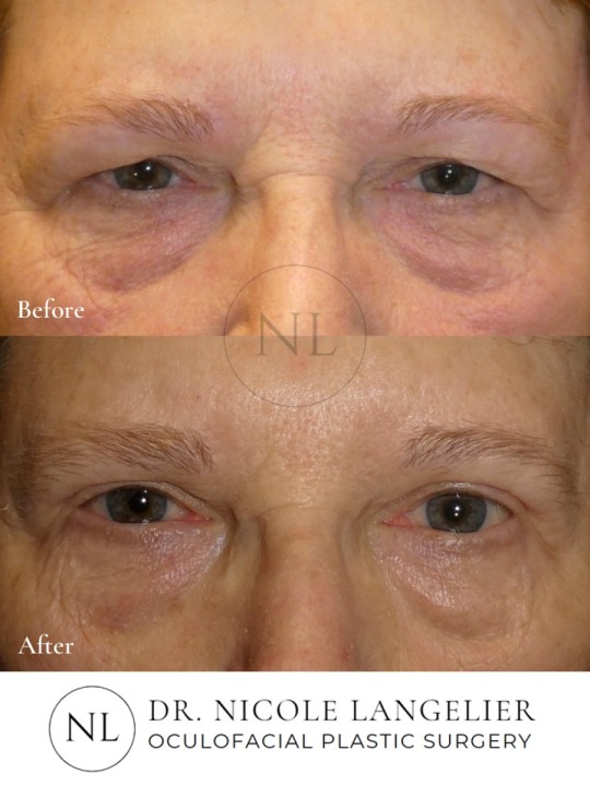 Female Upper Eyelid Blepharoplasty