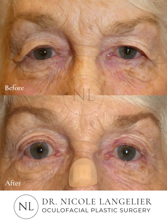 Bilateral Upper Eyelid Blepharoplasty