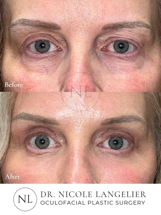 Female Upper Eyelid Blepharoplasty
