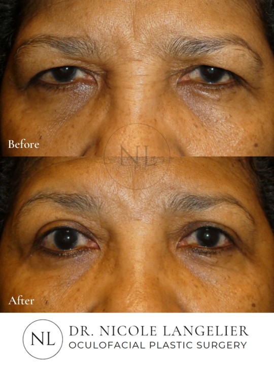 Female Upper Eyelid Blepharoplasty