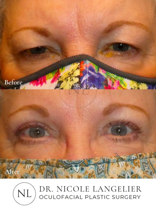 Female Upper Eyelid Blepharoplasty