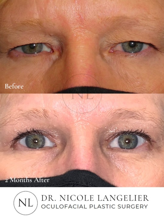 Female Upper Eyelid Blepharoplasty