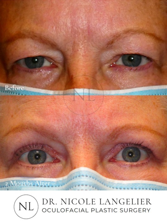 Bilateral Upper Eyelid Blepharoplasty