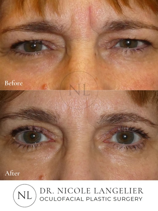 Female Upper Eyelid Blepharoplasty