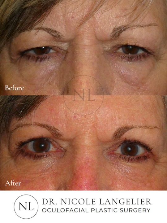 Female Upper Eyelid Blepharoplasty