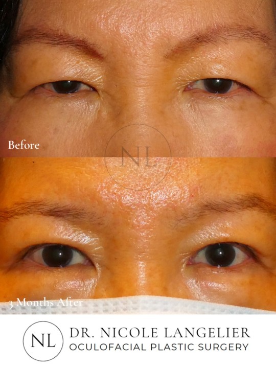 Female Upper Eyelid Blepharoplasty