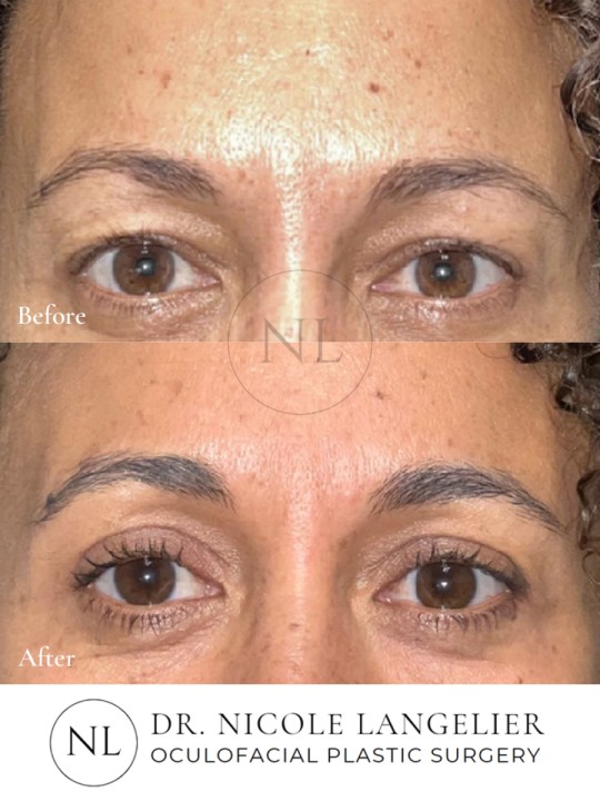 Female Upper Eyelid Blepharoplasty
