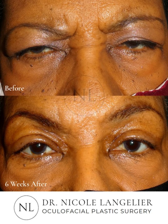 Bilateral Upper Eyelid Blepharoplasty