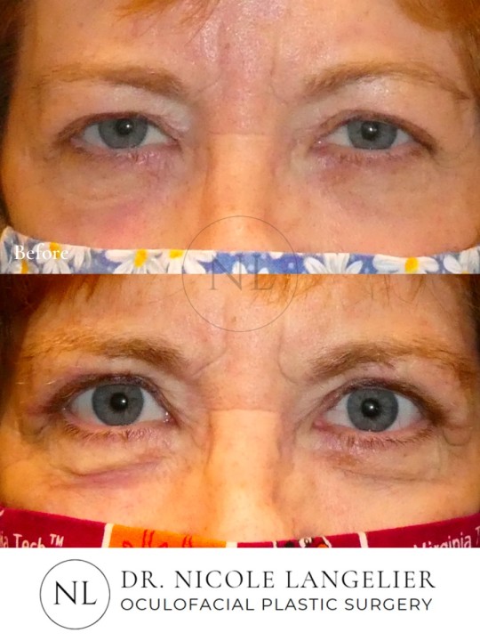 Female Upper Eyelid Blepharoplasty