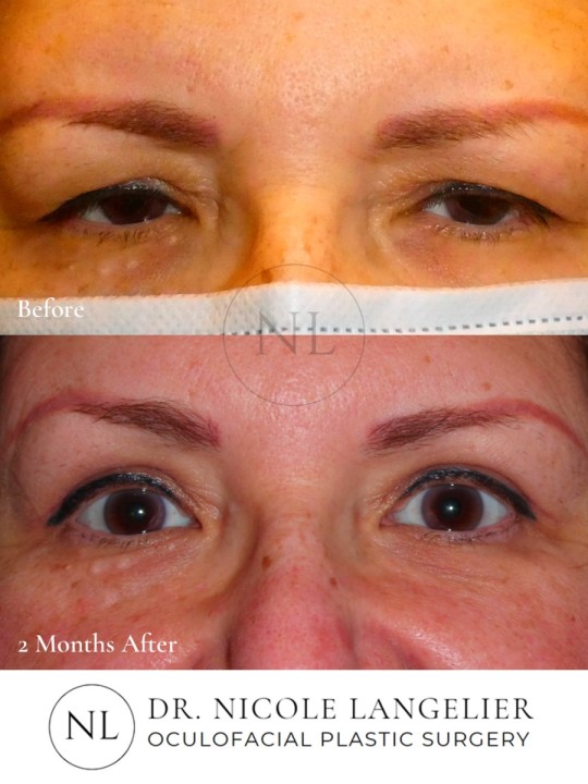 Female Upper Eyelid Blepharoplasty