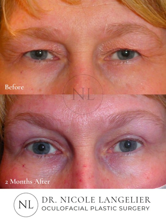 Female Upper Eyelid Blepharoplasty