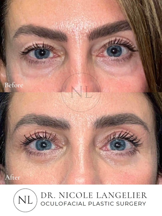 Female Upper Eyelid Blepharoplasty