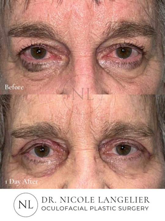 Female Upper Eyelid Blepharoplasty