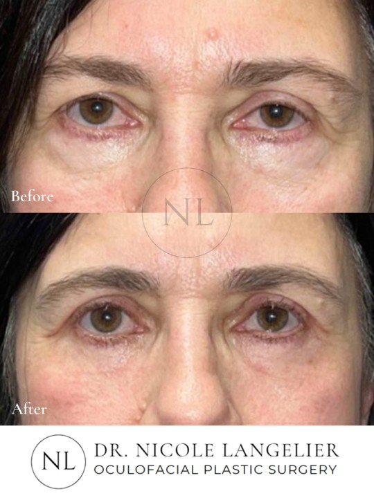 Female Upper Eyelid Blepharoplasty