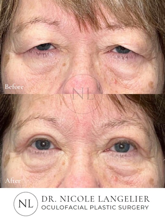Female Upper Eyelid Blepharoplasty