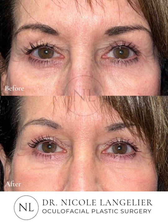 Female Upper Eyelid Blepharoplasty