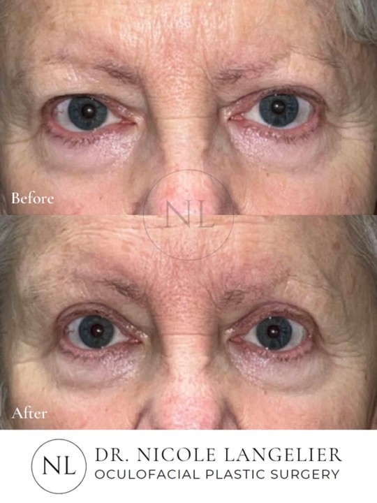 Female Upper Eyelid Blepharoplasty