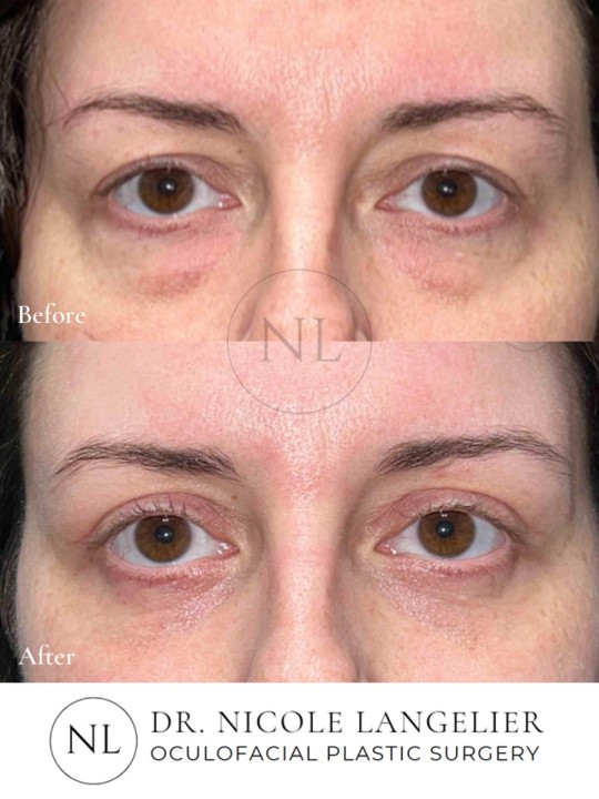 Female Upper Eyelid Blepharoplasty