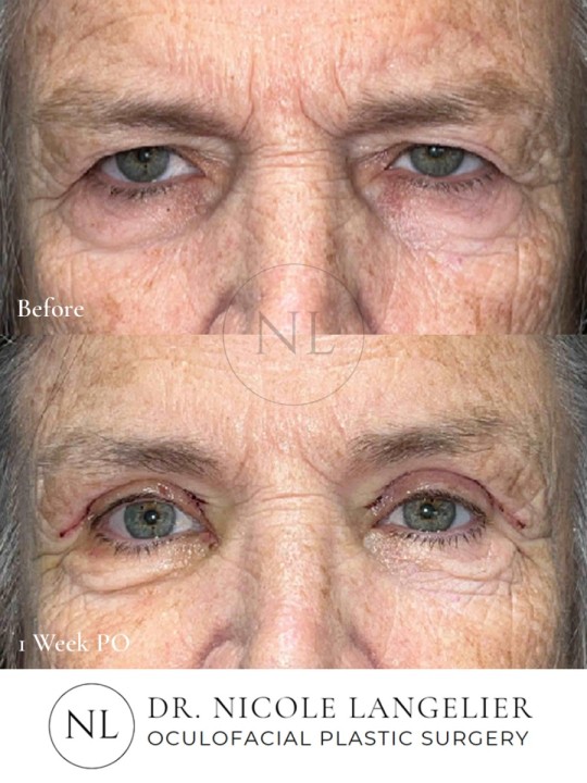 Female Upper Eyelid Blepharoplasty