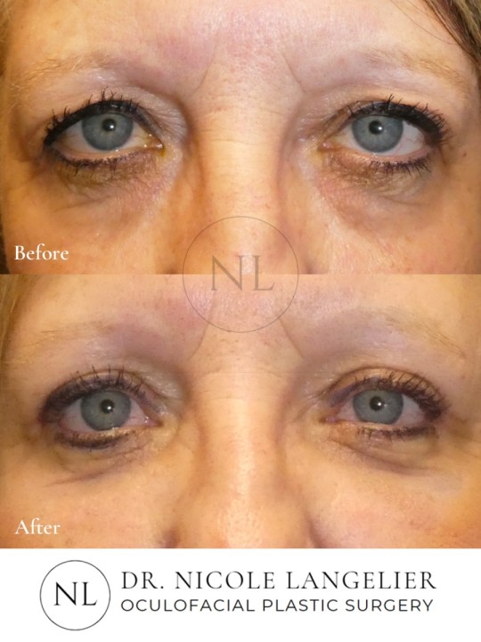Female Upper Eyelid Blepharoplasty