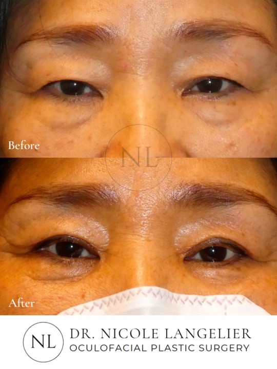 Female Upper Eyelid Blepharoplasty