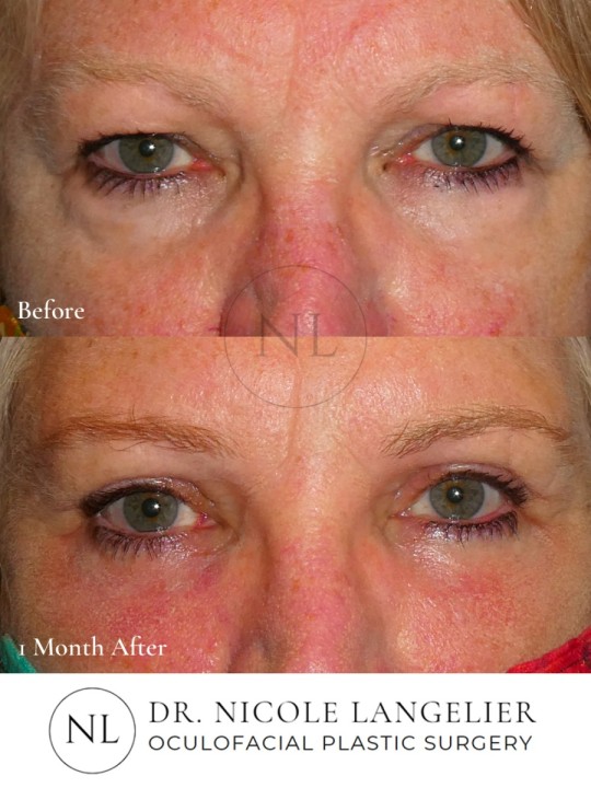 Female Upper Eyelid Blepharoplasty