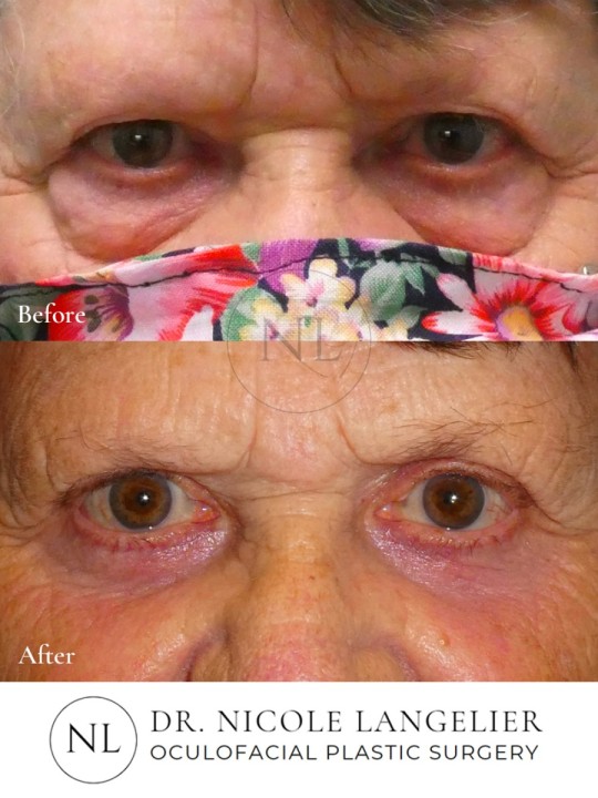 Female Upper Eyelid Blepharoplasty