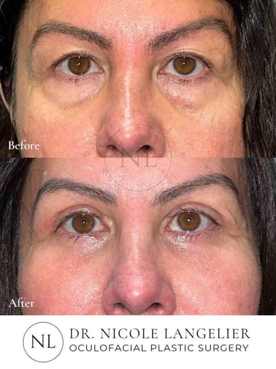 Female Upper and Lower Eyelid Blepharoplasty