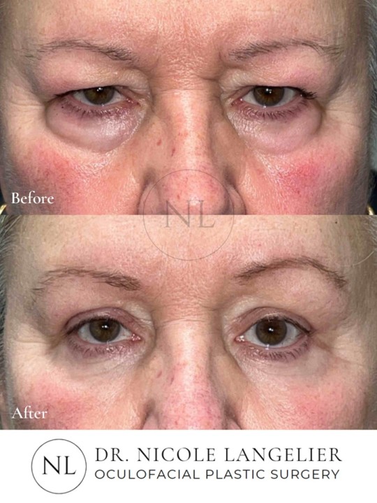 Female Upper and Lower Eyelid Blepharoplasty