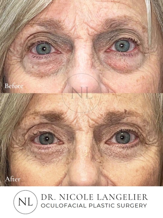 Female Upper and Lower Eyelid Blepharoplasty