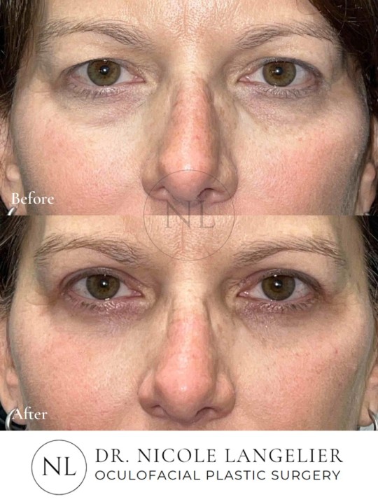 Female Upper and Lower Eyelid Blepharoplasty
