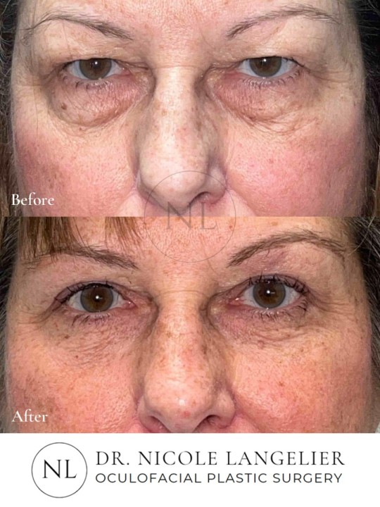 Female Upper and Lower Eyelid Blepharoplasty