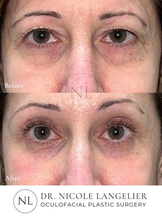 Female Upper and Lower Eyelid Blepharoplasty
