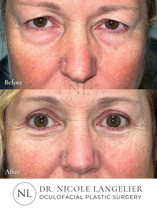 Female Upper and Lower Eyelid Blepharoplasty