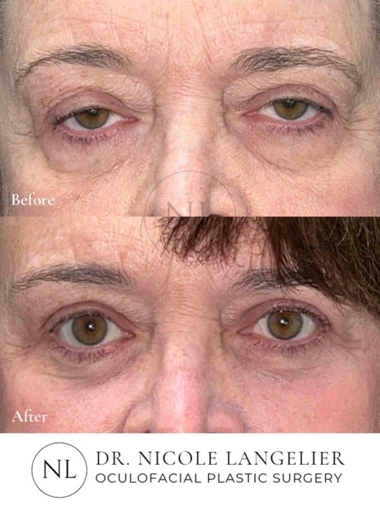 Female Upper and Lower Eyelid Blepharoplasty