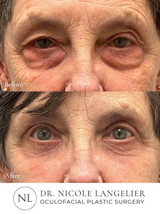Female Upper and Lower Eyelid Blepharoplasty
