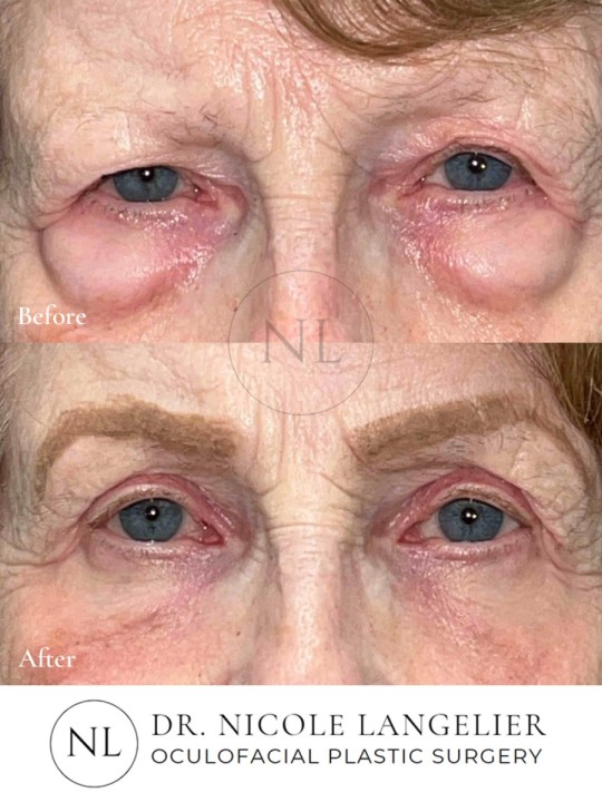 Female Upper and Lower Eyelid Blepharoplasty