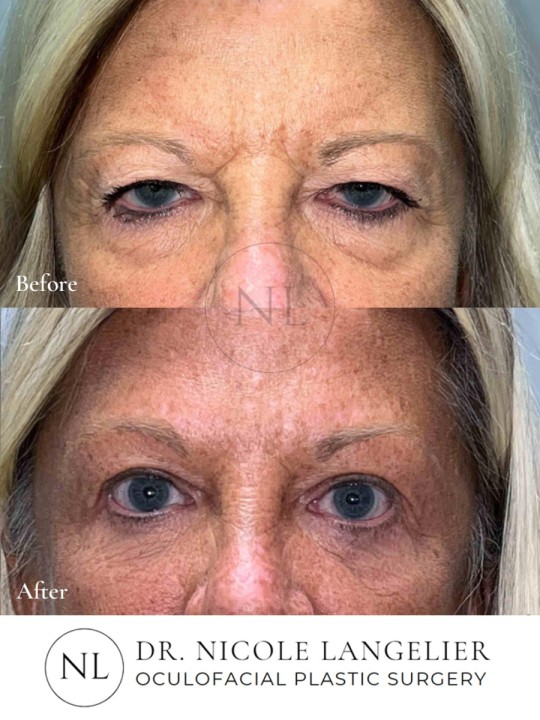 Female Upper and Lower Eyelid Blepharoplasty