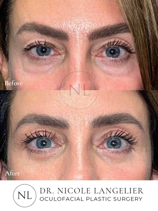 Female Upper and Lower Eyelid Blepharoplasty