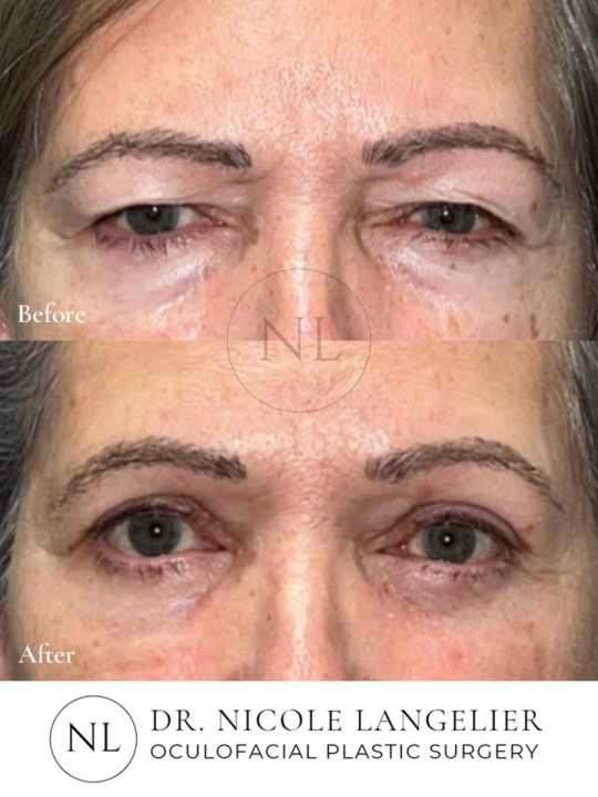 Female Upper and Lower Eyelid Blepharoplasty