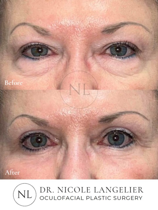 Female Upper and Lower Eyelid Blepharoplasty