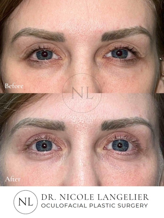 Female Upper and Lower Eyelid Blepharoplasty