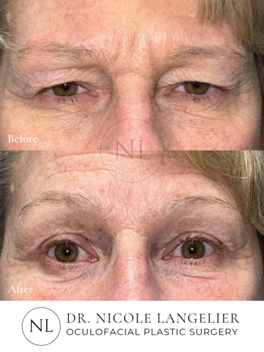 Female Upper and Lower Eyelid Blepharoplasty