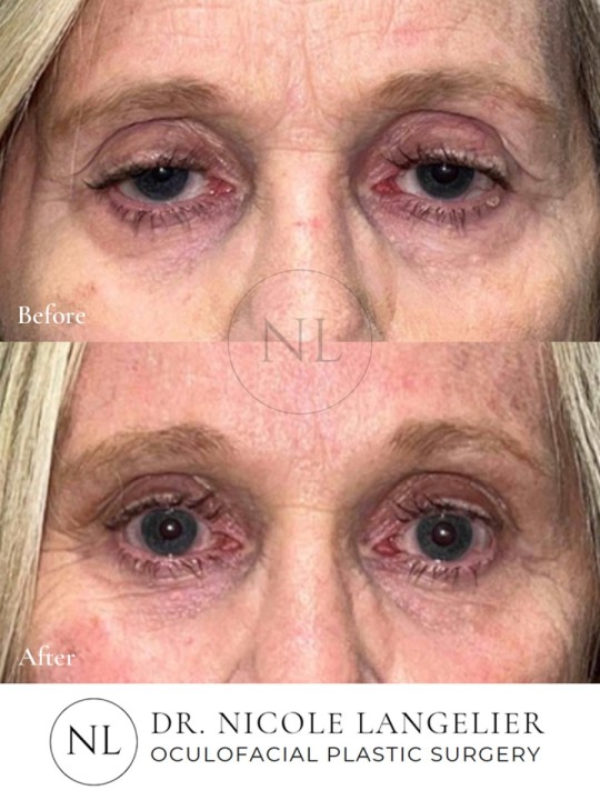 Female Upper and Lower Eyelid Blepharoplasty